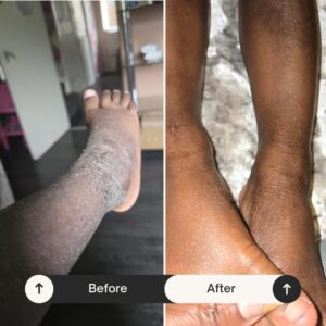 Alternative view of Eczema Psoriasis & Various Skin Conditions